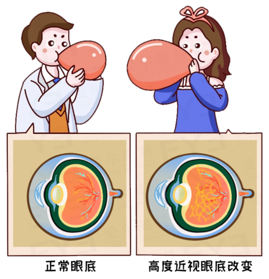 兰州爱尔医生科普：近视手术到底动了眼睛的哪个部分？(图2)