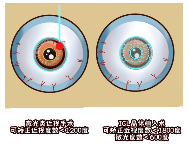 兰州爱尔医生科普：近视手术到底动了眼睛的哪个部分？(图1)