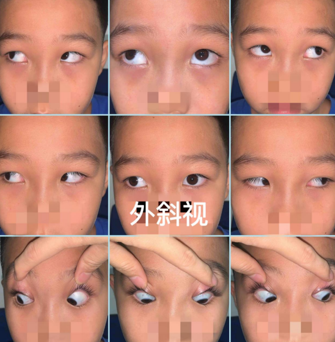 无法正眼看人别慌微创手术让您轻松改斜归正