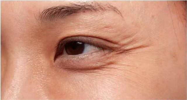 郑州美莱科普眼周会有一些什么样的衰老问题?该怎么样解决?