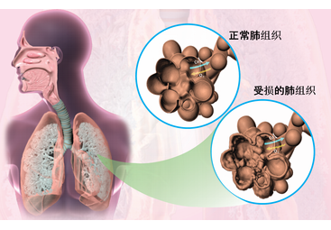 間質性肺疾病(ild),特發性間質性肺炎(iip)的概念與分類特發性肺纖維