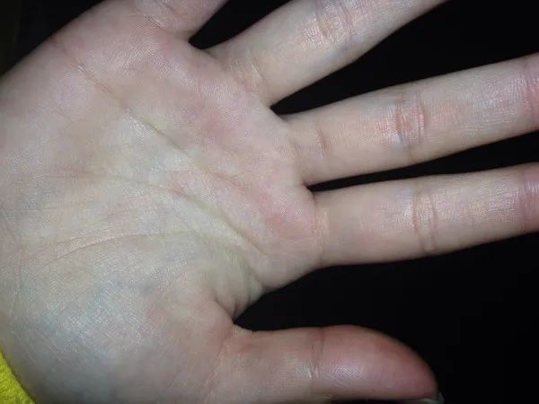 掌心青紫发黑手心发黄说明脾胃功能虚弱,如果再加上大鱼际比较扁平,那