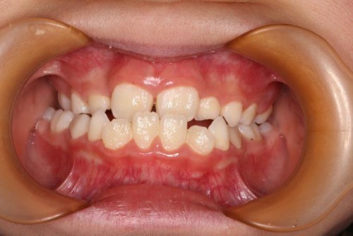 身边好医生┃吃手指,咬嘴唇,孩子这些不良习惯可能会