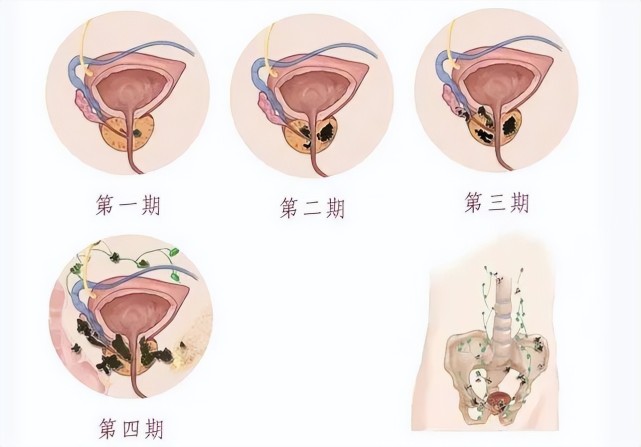 前列腺鈣化灶與前列腺炎有什麼關係?它的形成主要有這3個特點