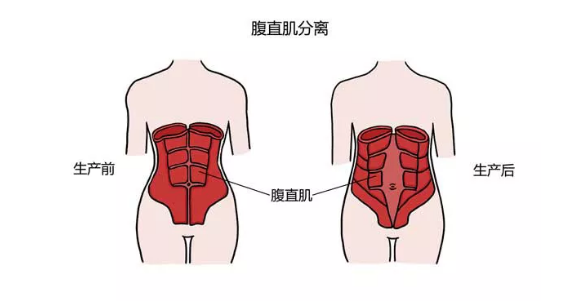 腹直肌分离4指时肌肉张力不足(脏腑易移位下垂)腹直肌分离3指需修复