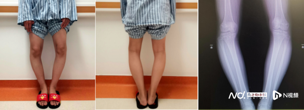 花季女孩o型腿怕见人,截骨矫形终于实现双膝并拢_腾讯新闻