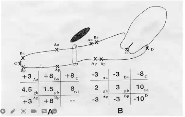 pop-q评分体系在盆腔器官脱垂中的应用