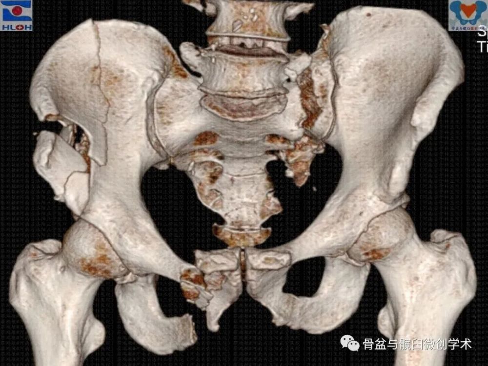 骨盆骨折分型中的邏輯混亂之一二_騰訊新聞
