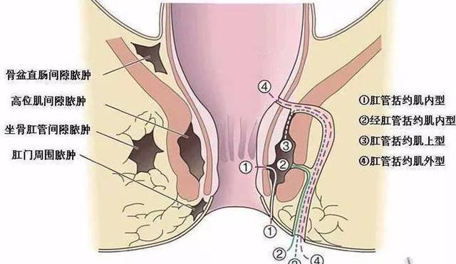 深圳天元中醫肛腸醫院肛周膿腫吃消炎藥行不行