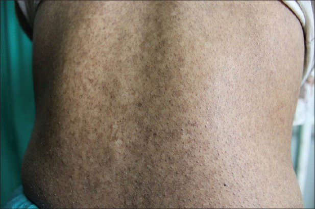 网状色素性皮病的病情可轻可重,个别患者除了缺失指纹,并无其他明显不