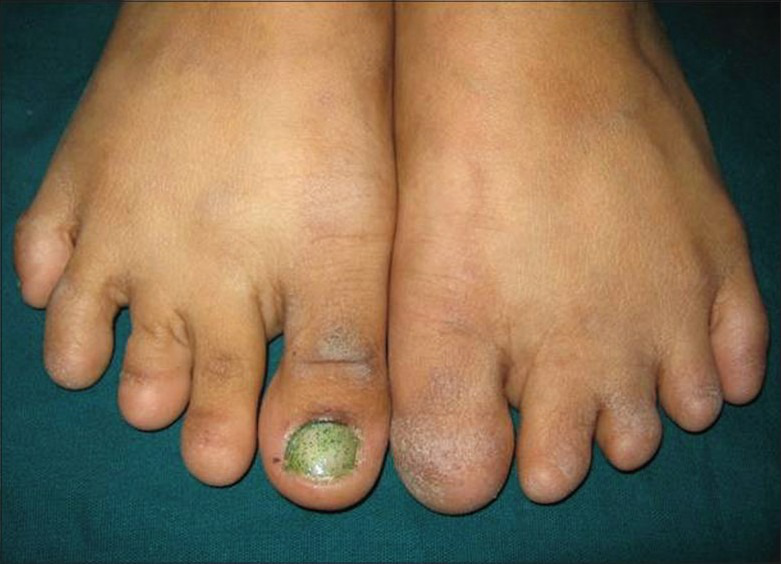 除了右脚大脚趾外,患者所有趾甲都缺失,图片来源参考文献[5]这种罕见