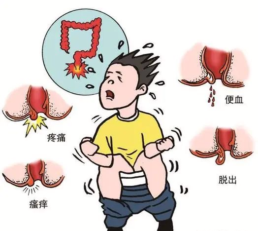 痔疮的症状有些什么这个法子肉球真的会掉
