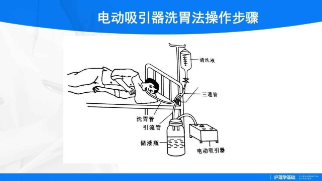 所以经常会使用胃管洗胃法