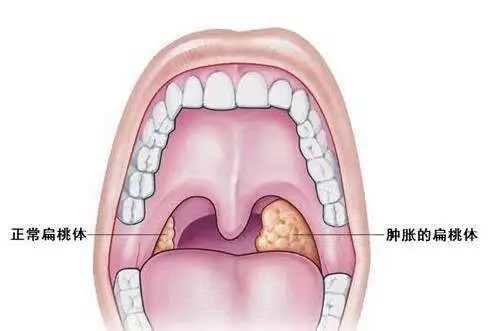 咽鼓管圆枕增生图片