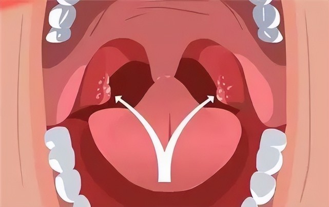 总是口臭,咽喉异物感,医生竟从男子喉咙里取出蚕豆大小的石头