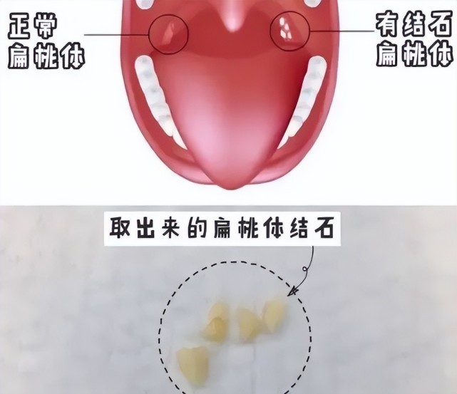 喉部结石图图片