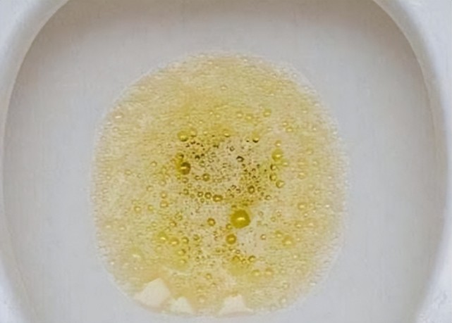 小便,就要检查下自己的肾脏健康情况了,及早重视,防止尿毒症的到来