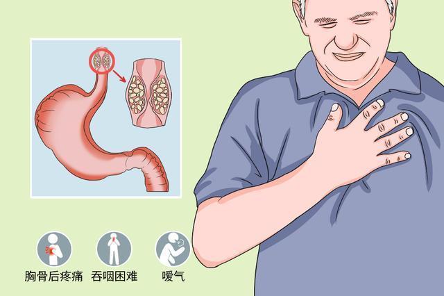 食道癌早期是什么症状(食道癌早期是什么症状做什么检查)-第2张图片-鲸幼网