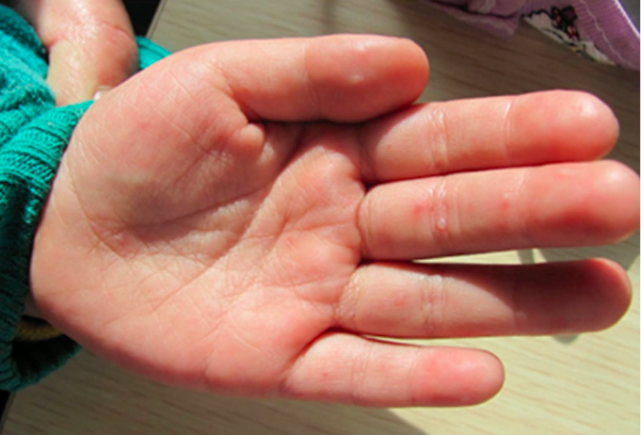 食欲减退,口腔黏膜,手掌,脚心四周有红色的疱疹时家长要小心了,因为