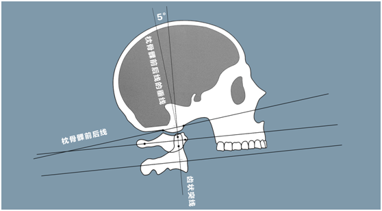齒狀突線與枕骨髁前後線的垂線形成的夾角為5度時為枕骨與寰椎的最佳