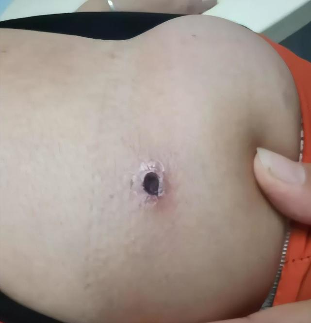 不明原因高烧多脏器衰竭多人被这种小虫子咬医生紧急提醒