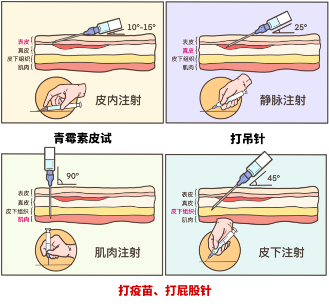 胸腺肽皮下针注射部位图片