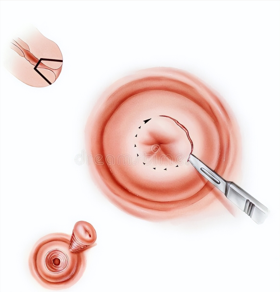 派特靈派特生物精選宮頸錐切除了leep還有哪些錐切方法