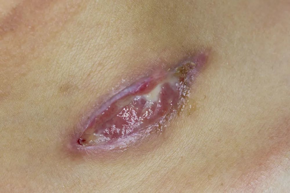 主任我缝的伤口怎么总是长不好啊