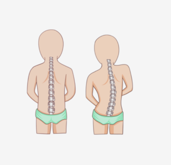 超500万中小学生脊柱侧弯!赶紧带孩子来免费筛查吧