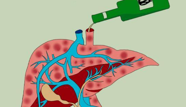 喝酒还不节制好好的肝脏被你喝成酒精肝下一步可就是肝硬化