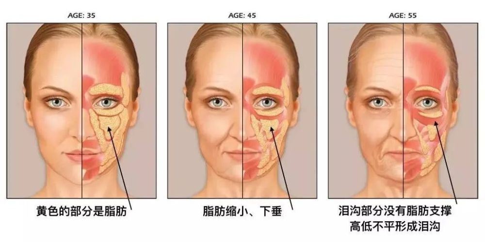 下衔脸颊,与苹果肌相邻,这些部位主要以皮下组织,肌肉,脂肪垫等软组织