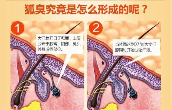 狐臭怎么治（狐臭怎么治疗最有效的土方法）-第2张图片-潮百科