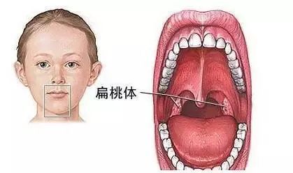 舌扁桃体发炎症状图片图片