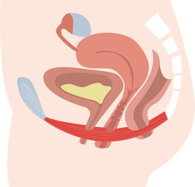 生育對身體的四大損傷盆底肌常常被忽略