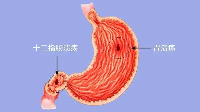 最常见的就是胃溃疡和十二指肠溃疡