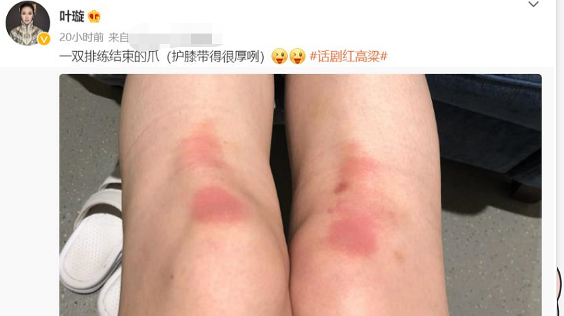 叶璇话剧排练太卖力,膝盖受伤淤青一大片,被男搭档大力搂抱举起_腾讯