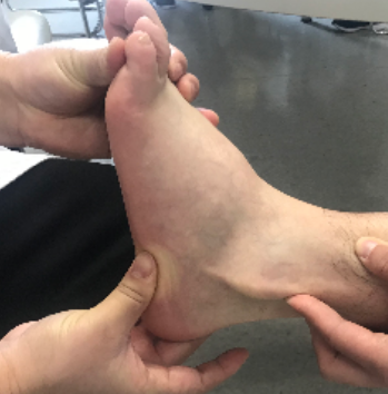 腓骨肌腱脱位不要再误诊为外踝扭伤了