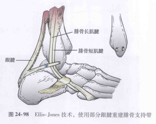 腓骨头附着的肌腱图片