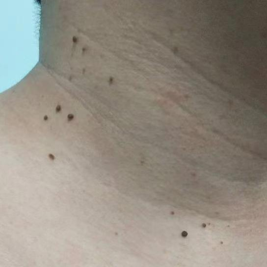 西安小伙脖子上长"小肉揪",居然是hpv感染