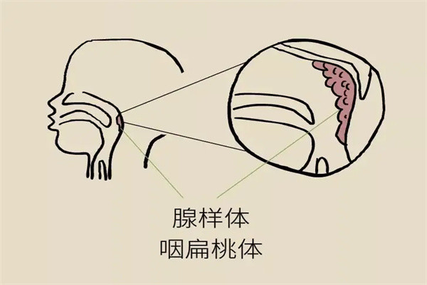 腺样体肥大危及一生?正确应对可减少伤害