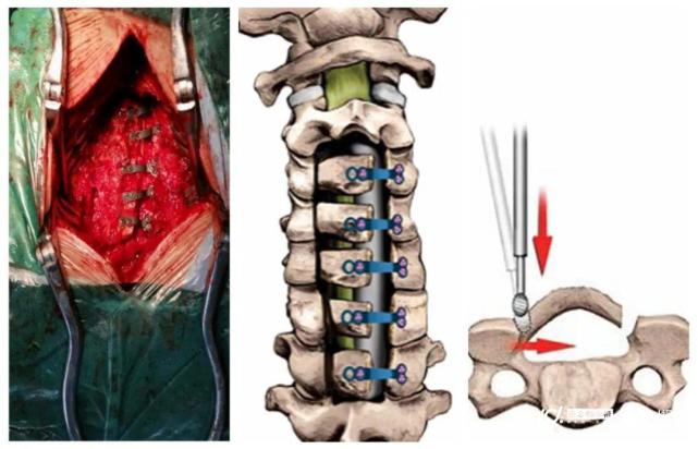 广州一阿伯骑车摔伤查出瘫痪,一次颈椎手术让他站起来_腾讯新闻