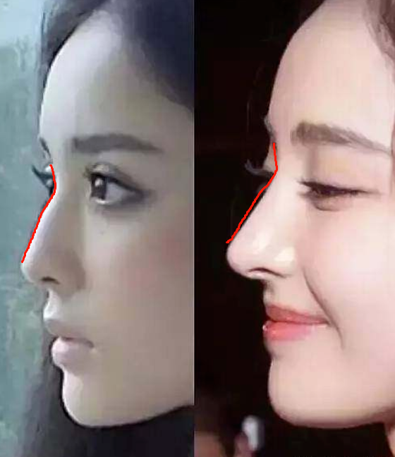 金晨鼻孔窄长,娜扎变形三角鼻孔,6位明星动鼻后遗症露馅了