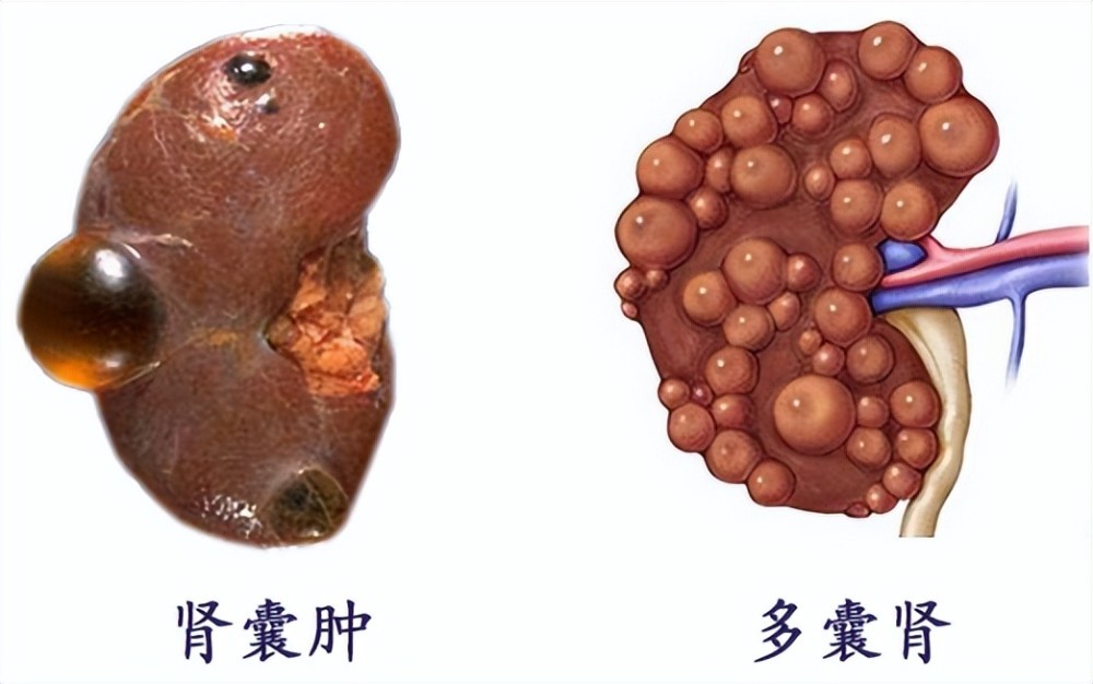 1,預防外傷多囊腎的囊腫會隨著時間的延長而不斷地腫大,囊內的壓力也