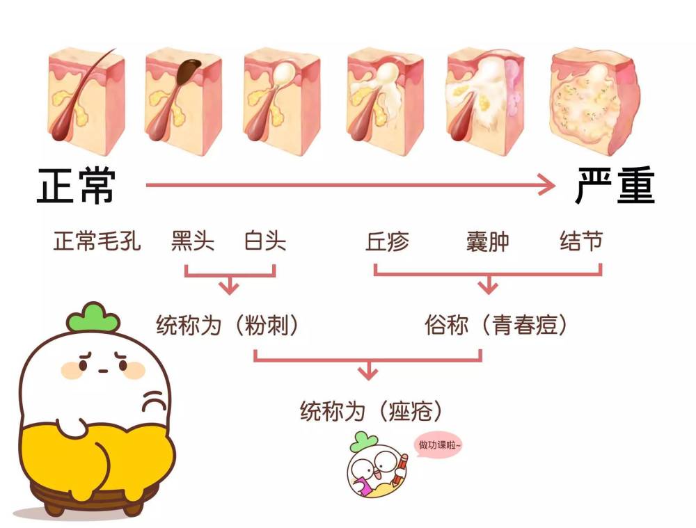 痤疮为何反反复复?原因有这些!插图1