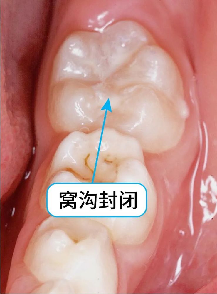 窝沟封闭是预防窝沟龋坏最有效的方法,你家小孩做了吗?_腾讯新闻
