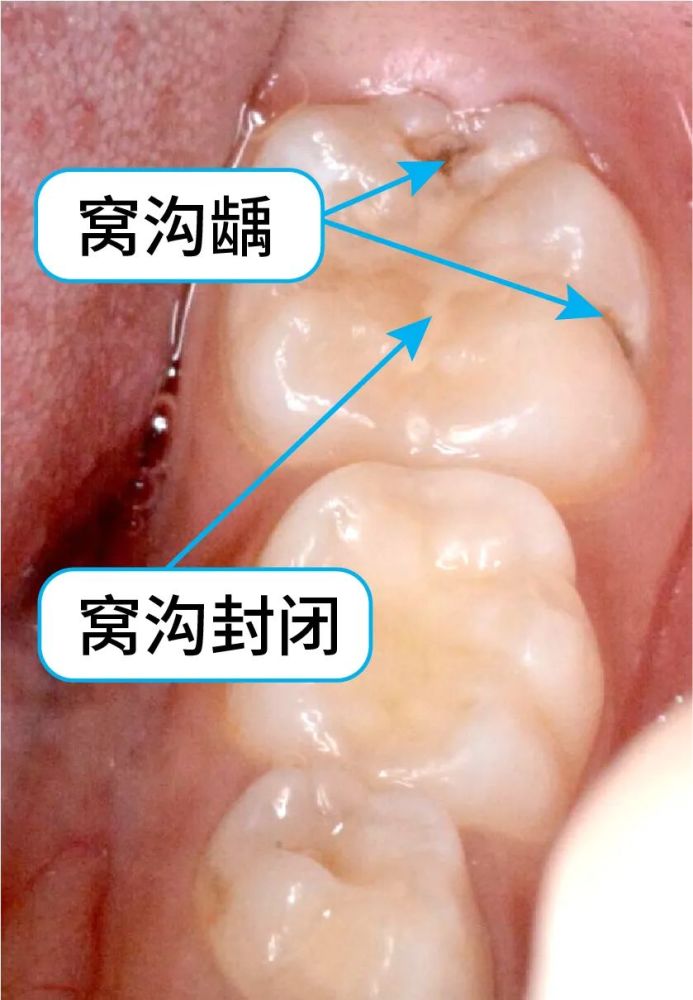 窝沟封闭是预防窝沟龋坏最有效的方法,你家小孩做了吗?_腾讯新闻