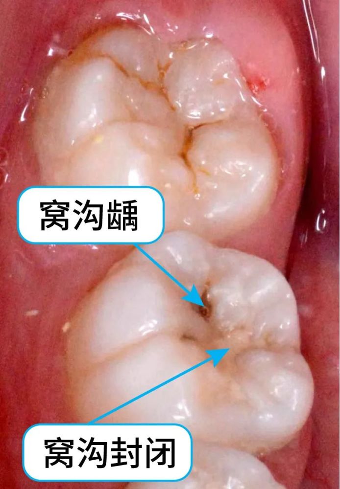 窝沟封闭是预防窝沟龋坏最有效的方法,你家小孩做了吗?_腾讯新闻