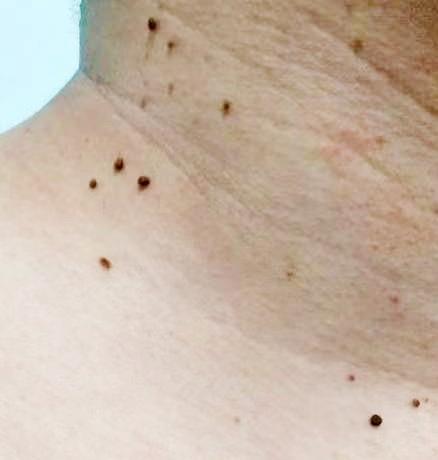 小伙脖子上长了很多"小肉揪"居然是hpv感染