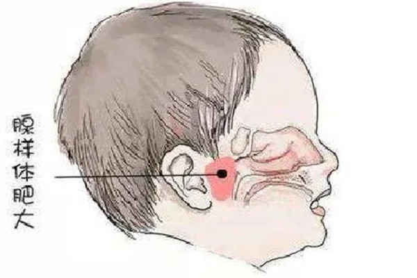 腺樣體面容一經形成,再難恢復?腺樣體肥大治療還是要趁早