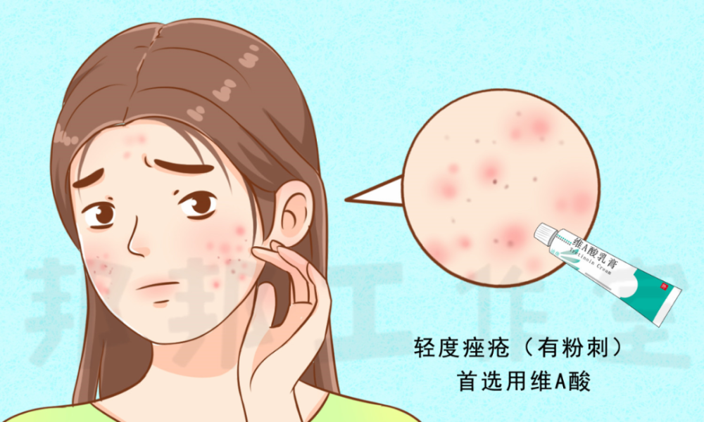 外用药物使用方便,副作用小,目前外用的祛痘药物有哪些呢?